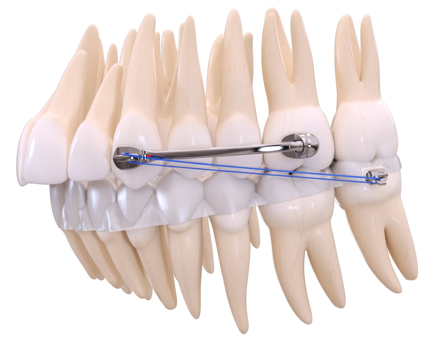 Smile bars work to correct a patient's bite.