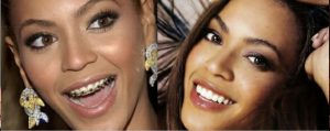 Celebrities With Braces: From Prince Harry to Beyoncé